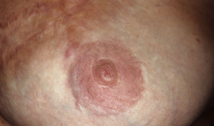 Nipple tattoo | areola tattoo | tattooing nipples after breastreconstruction Nipple tattoo | areola tattoo | tattooing nipples after breastreconstruction